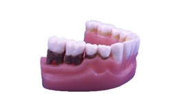 DEPER-001 2x Natural-Size Lower Jaw Model With Periodontal Disease