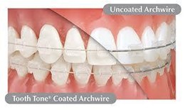 Dây cung thẩm mỹ Ortho Technology