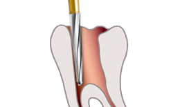 Mũi Endo-Z Dentsply