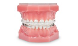 Ceramic Brackets Tubes Are Metal and Wires Are Made With White Coated Niti Wire