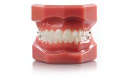 Ceramic Brackets Tubes and Wires Are Made With Metal