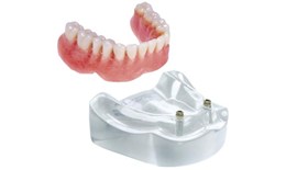 DEDEN-005 Implant Overdentures-Locator