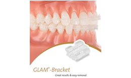 Mắc cài sứ thẩm mỹ Glam