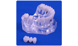 DECB-001 Single Tooth Missing Implant vs Bridge