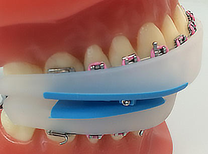 Máng Twicare (Khí cụ chỉnh nha đa chức năng)