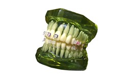 Mẫu hàm có mắc cài