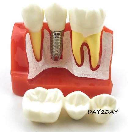 Mẫu hàm mô hình tư vấn so sánh Implant và Cầu răng