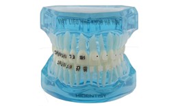 Mẫu hàm tư vấn chỉnh nha mắc cài sứ và kim loại