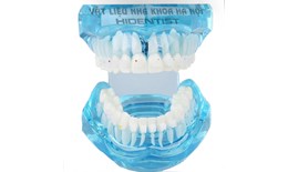 Mẫu hàm tư vấn chỉnh nha mắc cài sứ
