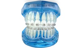 Mẫu kàm tư vấn chỉnh nha mắc cài kim loại