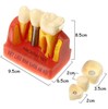 Mô hình tư vấn Implant và cầu răng