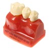 Mô hình tư vấn Implant và cầu răng