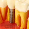 Mô hình tư vấn Implant và cầu răng
