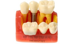 Mô hình tư vấn Implant và cầu răng