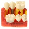 Mô hình tư vấn Implant và cầu răng