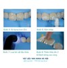Vật liệu loại bỏ đốm trắng – Icon Vestibular