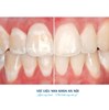 Vật liệu loại bỏ đốm trắng – Icon Vestibular